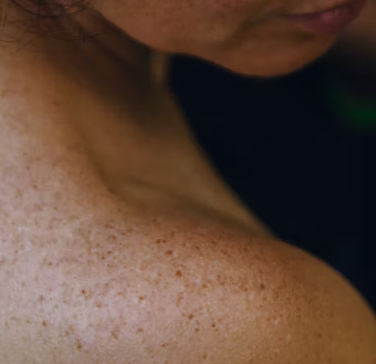 두드러기 치료방법 진단 기준 합병증