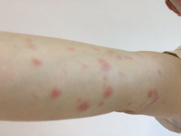 빈대에 물린 자국 사진