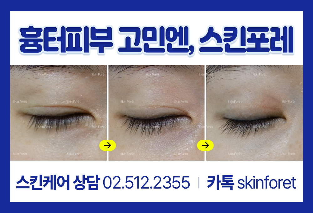 앞트임 수술 후 생긴 흉살과 몽고주름 변화된 전후 비교 이미지