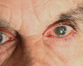 백내장 수술비용