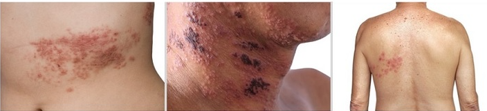 폭염에 감기인 줄 알았는데 ... 대상포진의 위험 관련 이미지