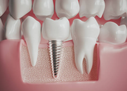 임플란트