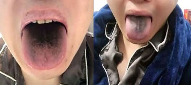 혓바닥에-관련된-병