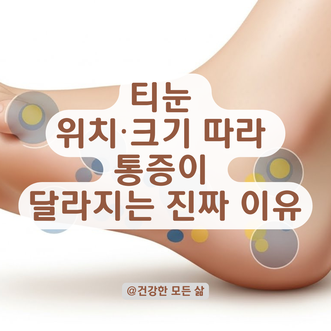 티눈 크기와 위치별 수술 시 통증 차이, 마취부터 회복관리까지 현실 가이드!