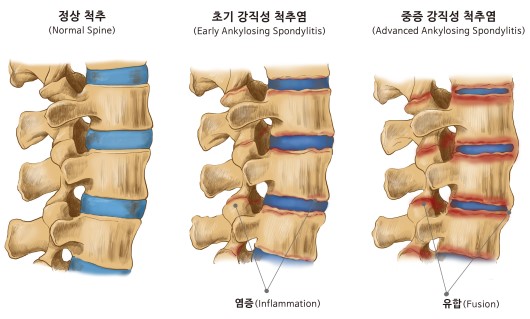 강직척추염 정도