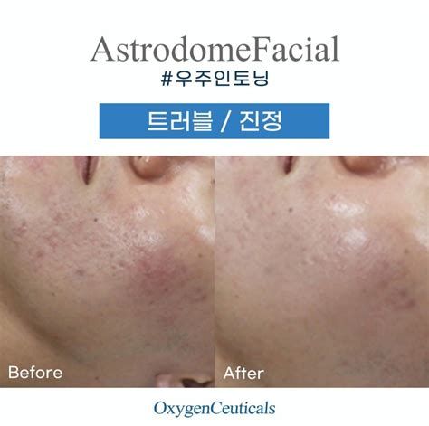 얼굴열감