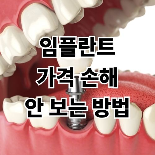 임플란트 가격 손해 안 보는 방법