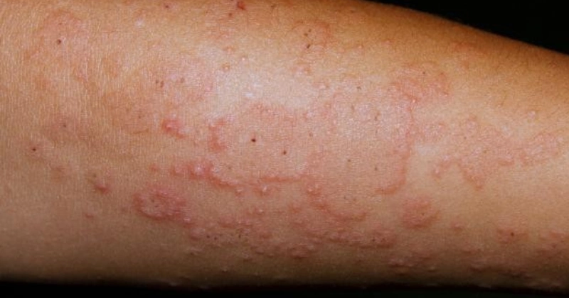 구진이 생긴 다형태광발진