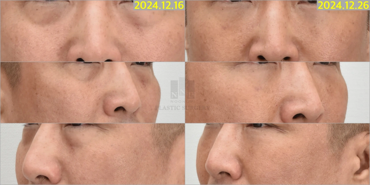 50대 눈밑지방재배치