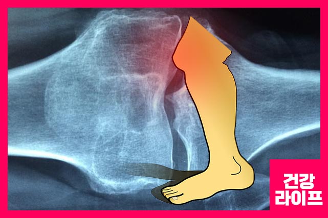 통풍 원인 - 요산 수치 증가, 유전적 요인