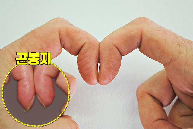 곤봉지 폐암 증상,진행 속도,건강 팁줌 매일꿀정보