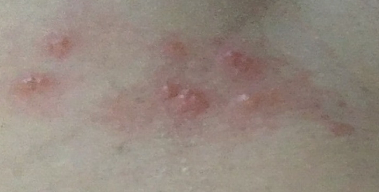 가벼운-대상포진