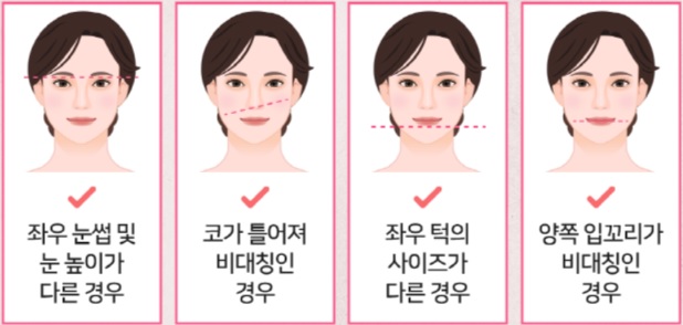 안면 비대칭 교정 및 예방법