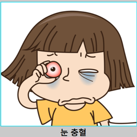 녹내장 증상 - 눈의 충혈