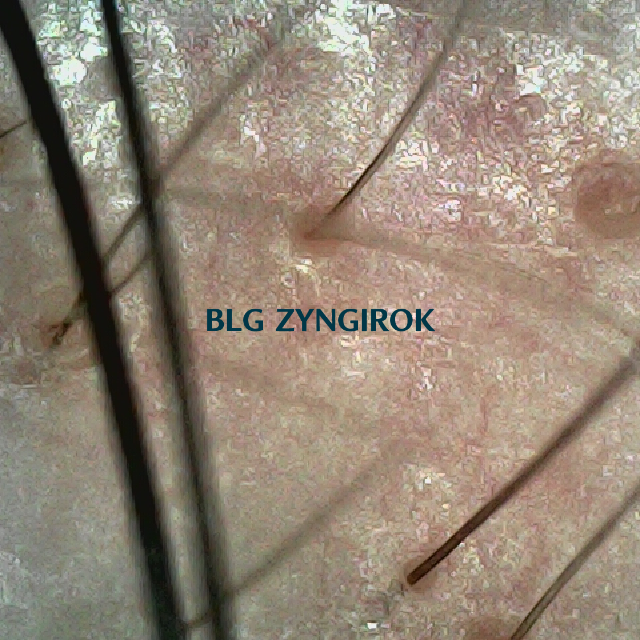 피나모아 복용 17주차 - 오른쪽 M자 부위 모습이다.