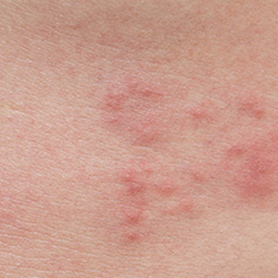 대상포진 초기증상