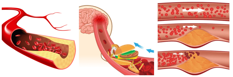 고지혈증 관련 사진 3개