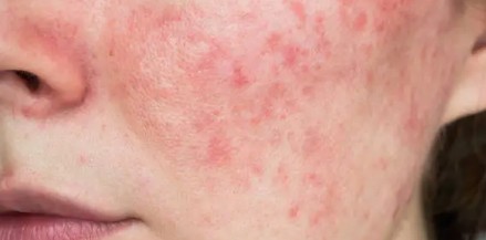 간 수치가 높으면 나타나는 증상6