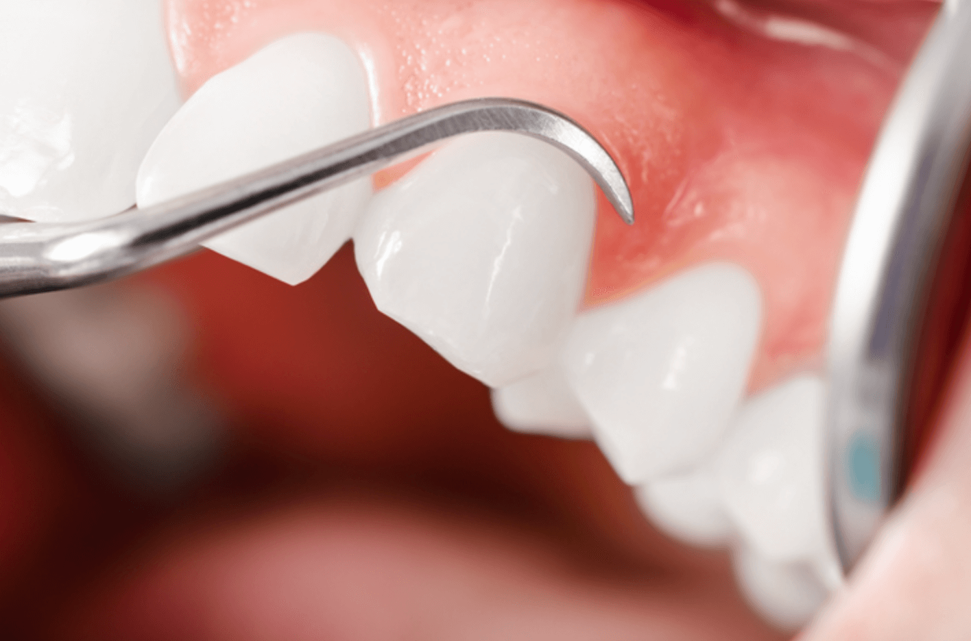 고름 주머니 원인