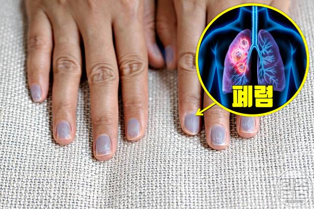 손톱 색깔 건강 손톱색깔 파란색 폐렴