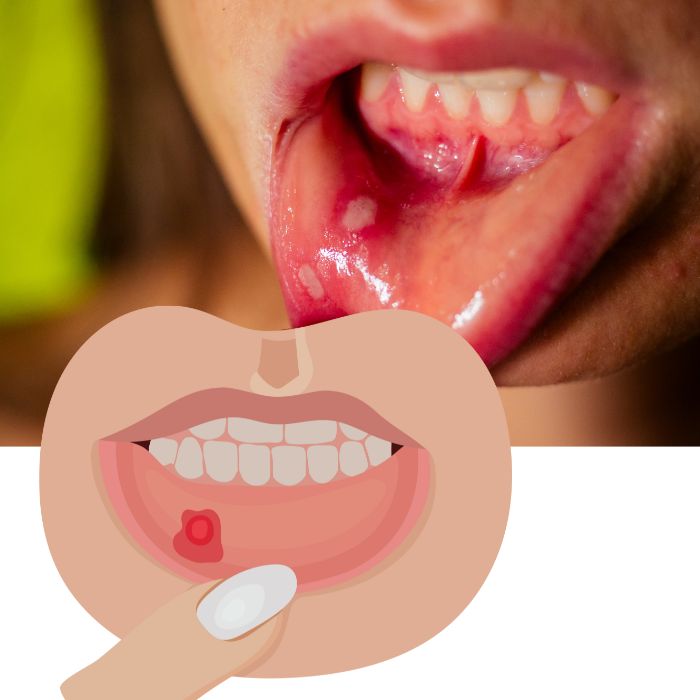 구내염 증상
