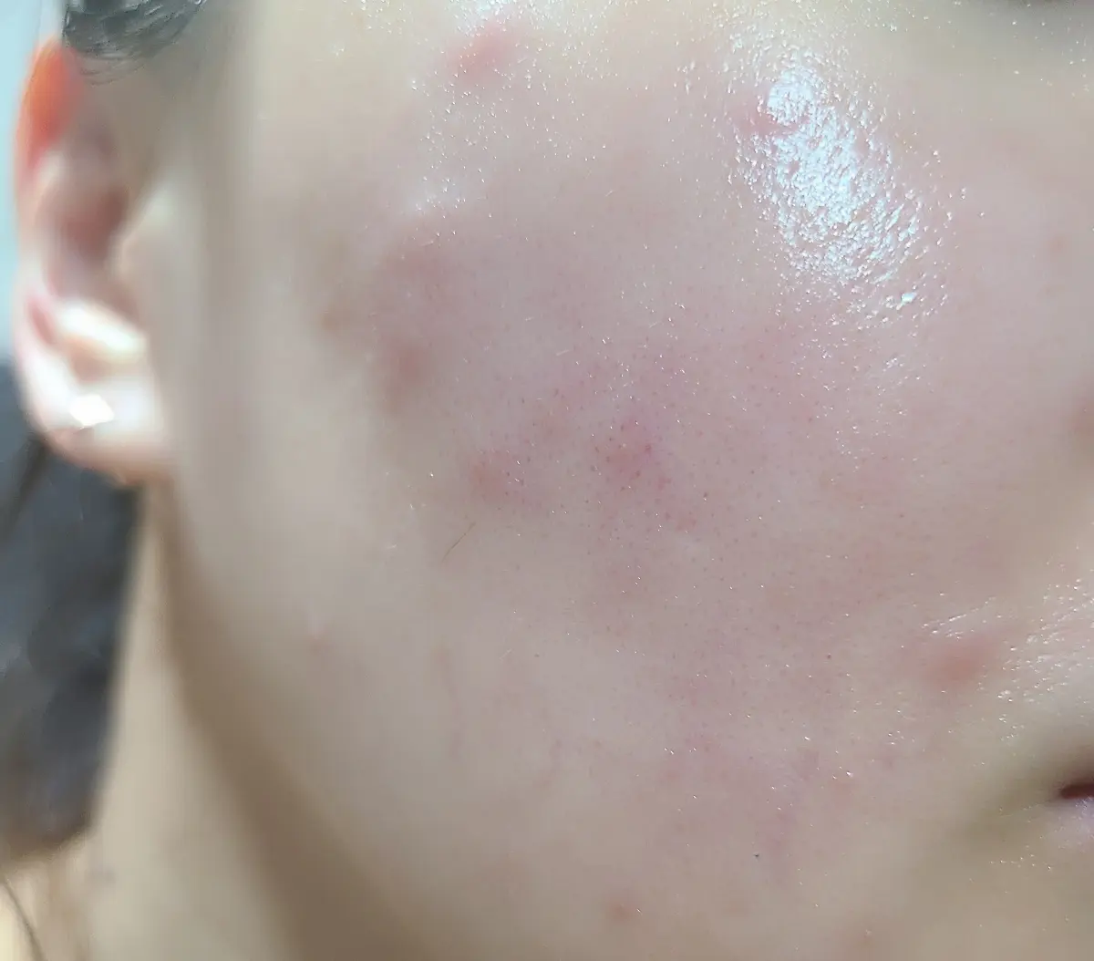 피코토닝-레이저-부작용-접촉성피부염-피부-뒤집어짐