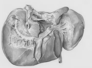 지방간 없애는 방법 지방간 증상 원인