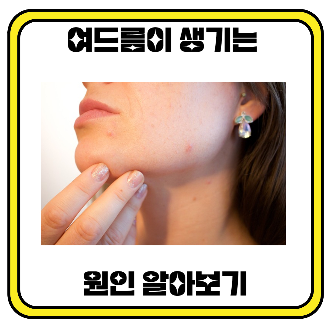 여드름이 생기는 원안 알아보기