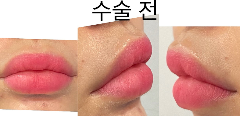 입술 축소수술 후기