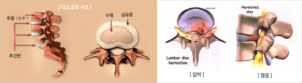 허리디스크 증상 허리디스크에 좋은 운동 다리저림 자가진단 치료법