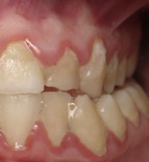 잇몸이 부었을 때 대처 방법
