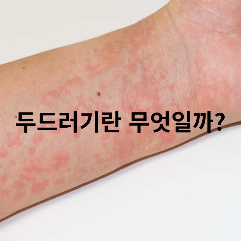 두드러기 간지러움 심할 때 해결방법과 원인