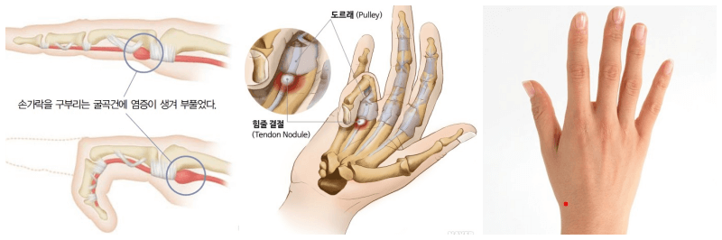 방아쇠수지 증후군, 양계혈 사진