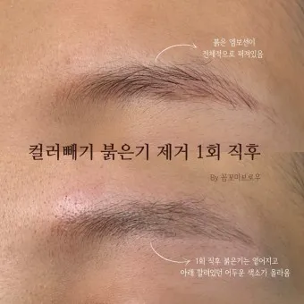 눈썹 문신 제거 방법 꿀팁_12