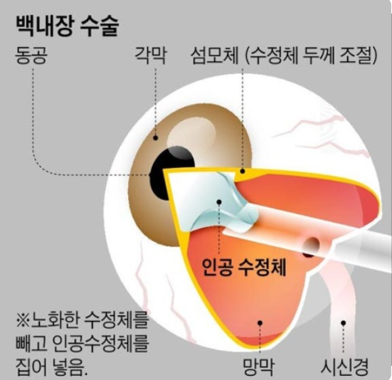 백내장 수술 발전과 인공수정체의 중요성 관련 이미지
