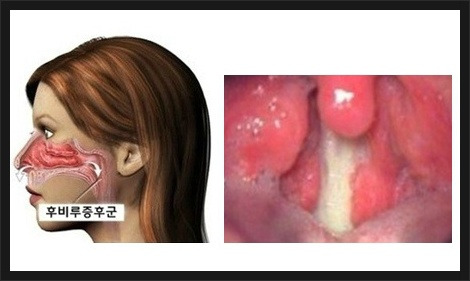 후비루증후군(출처 여의도이비인후과)