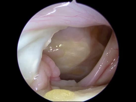 상완이두근건 이전술 &amp; 인공보강술 ❘ 어깨 회전근개 수술의 보조적 치료