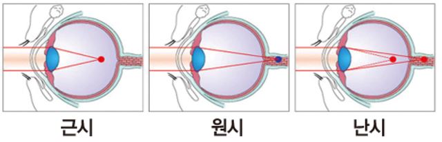 근시 원시 난시