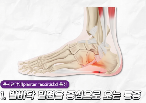 족저근막염1