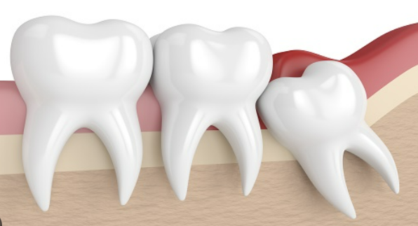사랑니 발치후 식사 알아보기 커피&amp;#44; 흡연&amp;#44; 음주 정보
