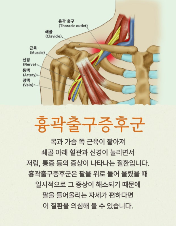 흉곽출구증후군