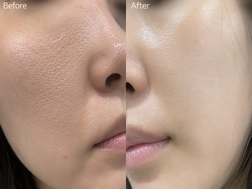 앞볼 및 나비존 늘어진 세로모공 탄력 케어 전후 비포애프터 비교 사진
