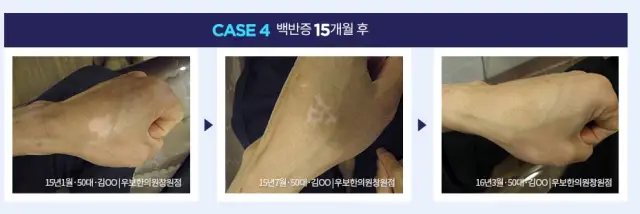 백반증 전문 우보환