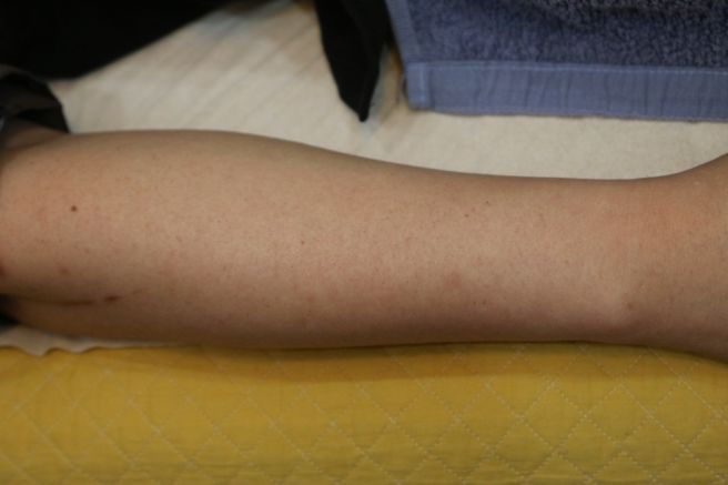 자반증 치료방법