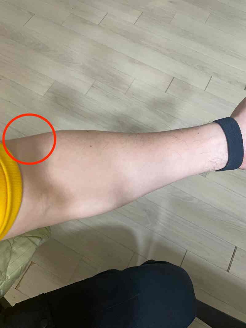 외측상과의 위치를 나타낸 이미지입니다.