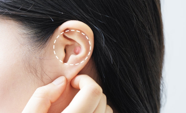 목 멍울 6가지 원인과 대처 방법