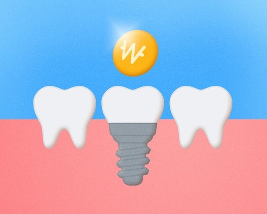 임플란트 비용 정리: 종류별 가격과 시술 기간