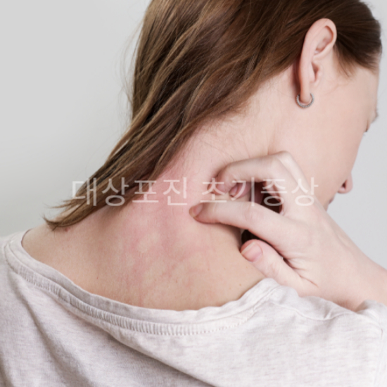 대상포진 초기 증상2