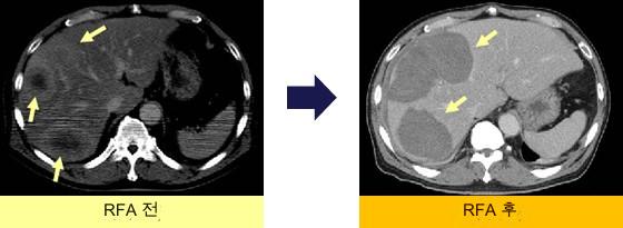 간암 라디오파 소작술