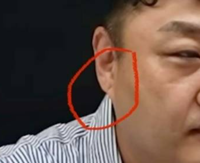 프랭크징후